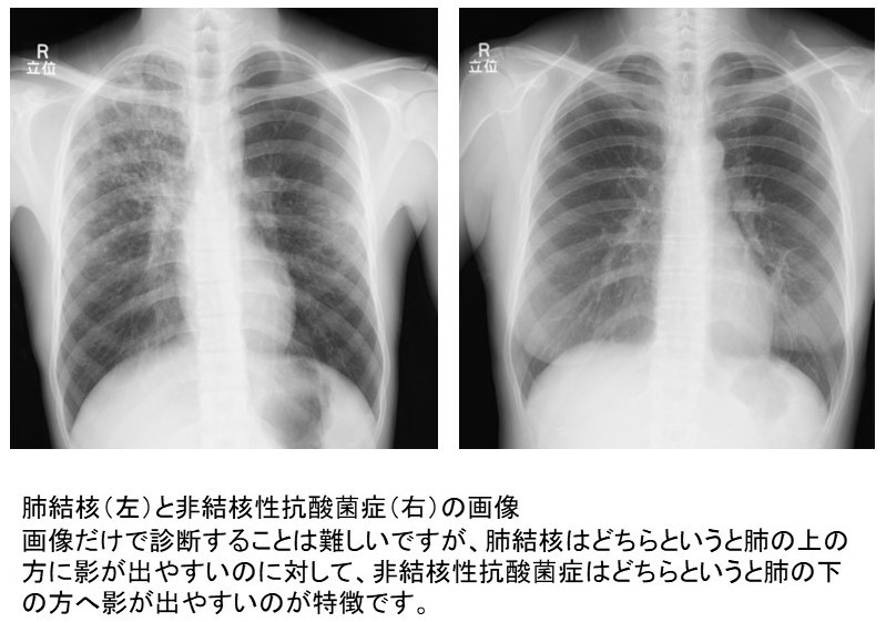 肺結核(左)と非結核性抗酸菌症(右)の画像